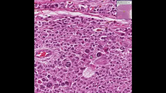 1.Adrenal--Adrenocortical carcinoma