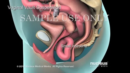 Pelvic Prolapse   Nucleus Health