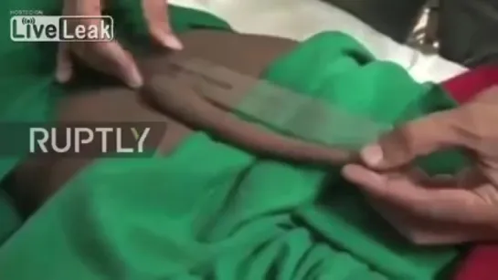 Indian teenager with 7 inch TAIL finally has growth removed