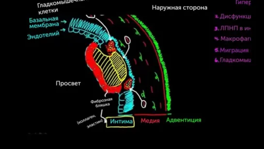 Патологии кровеносных сосудов. 3. Атеросклероз