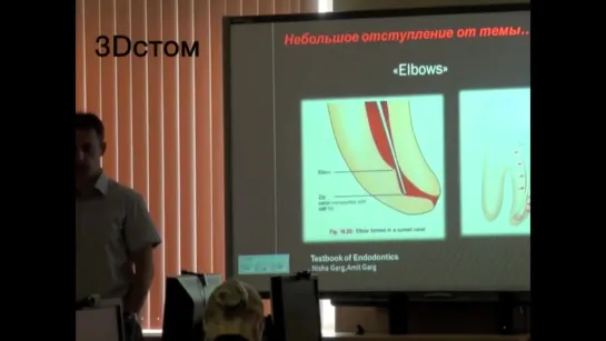 Перелечивание Извлечение гуттаперчи