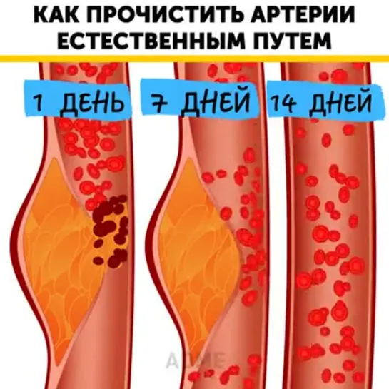 Чистим артерии