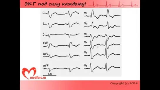 Урок 7. Видеокурс ЭКГ под силу каждому