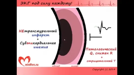 Урок 9. Видеокурс ЭКГ под силу каждому