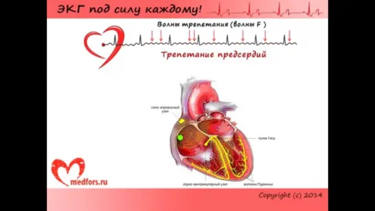 Урок 5. Видеокурс ЭКГ под силу каждому