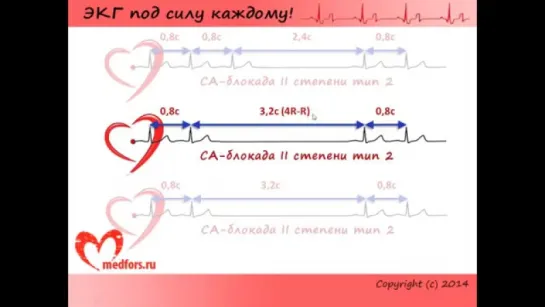 Урок 6. Видеокурс ЭКГ под силу каждому