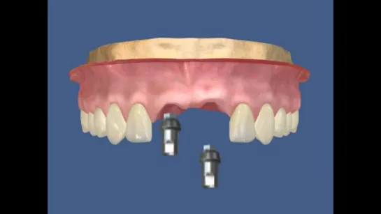 4. Имплантация - два имплантата (верхние центральные резцы)