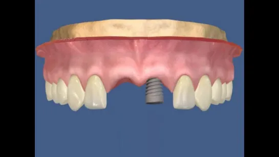 1.Имплантация - два имплантата (верхние центральные резцы) и костный транспланта