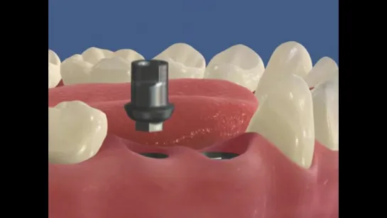 5.Имплантация - имплантаты в области нижних премоляров