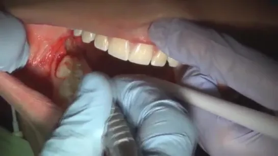 How to pull a wisdom tooth (fully impacted)