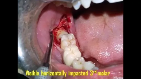 Surgical Extraction of Horizontally Impacted Mandibular Right 3rd Molar Case By