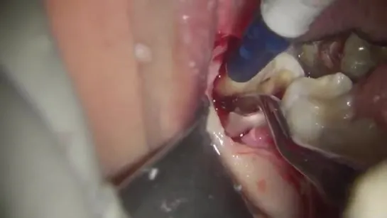 Lower third molar extraction with operative microscope and piezosurgery