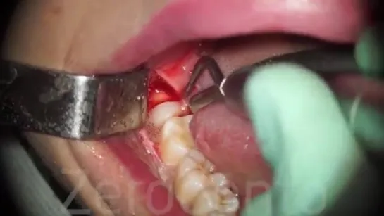 Horizontal semi-impacted wisdom tooth (sonic vs piezosurgery) - Dr. Fabio Cozzol