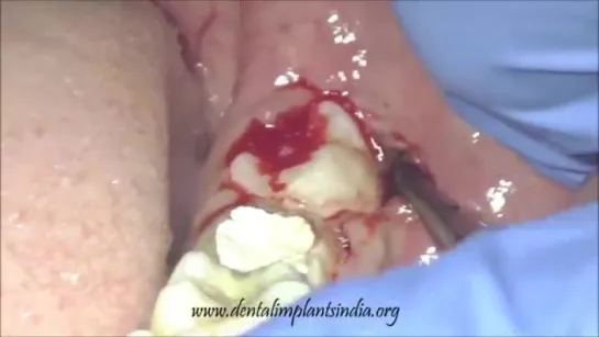 Removal of lower third molar with elevator