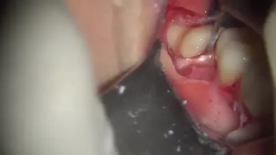 Lower third molar extraction with operative microscope and piezosurgery