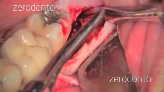 Dr. R. Barone - Dr. C. Clauser _ Impacted third molar conservative extraction an