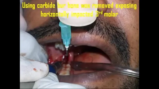 Surgical Extraction of Horizontally Impacted Mandibular Right 3rd Molar Case By