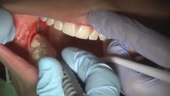 How to pull a wisdom tooth (fully impacted)