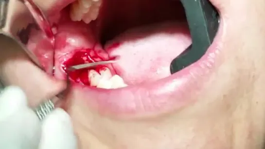 Surgical Ext of Lower Right Third Molar (#32)