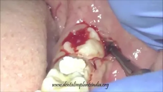 Removal of lower third molar with elevator