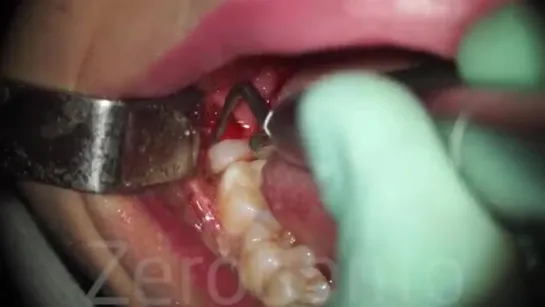 Horizontal semi-impacted wisdom tooth (sonic vs piezosurgery) - Dr. Fabio Cozzol