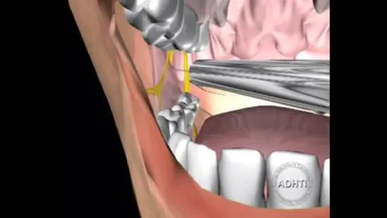Мандибулярная Анестезия 5