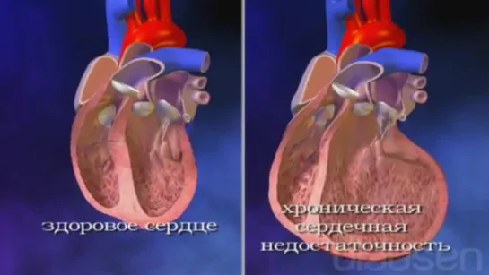 45. Хроническая сердечная недостаточность ХСН