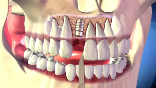 Установка зубного имплантата _ Анимация