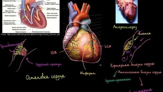 ИБС и сердечные приступы