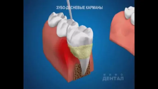 Снятие зубного камня и налета