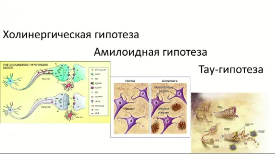 1. Болезнь Альцгеймера