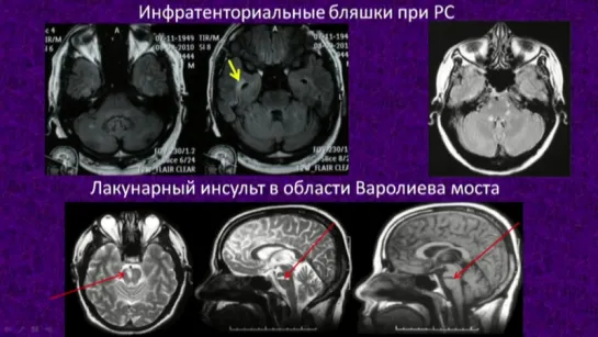 2. Рассеянный склероз. Часть 2.