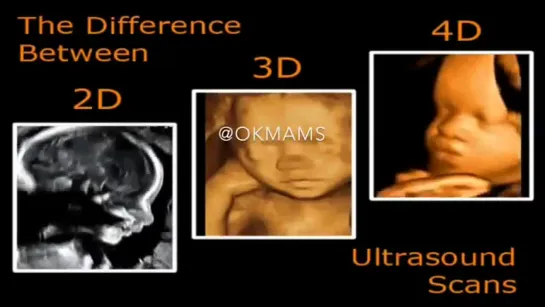 Разница между 2D, 3D, 4D ультразвуковым сканированием.