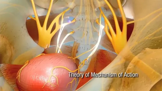 Medtronic Sacral Neuromodulation