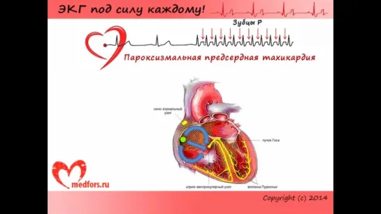 [5. ЭКГ под силу каждому] — Тахикардии, трепетания и фибрилляции