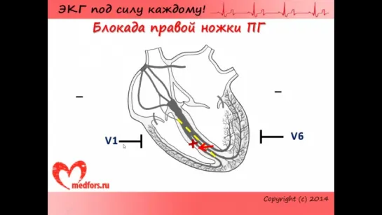 [7. ЭКГ под силу каждому] — Блокады, часть 2: блокады ножек пучка Гиса