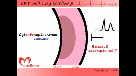 [9. ЭКГ под силу каждому] — Изменения ЭКГ при инфарктах, часть 1: общие вопросы