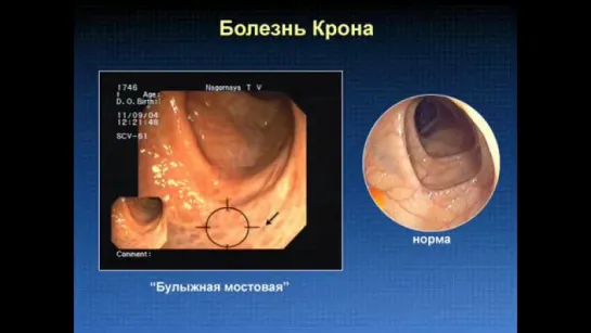 Болезнь Крона, симптомы, клиническая картина, эндоскопия болезни Крона © Crohns disease symptoms