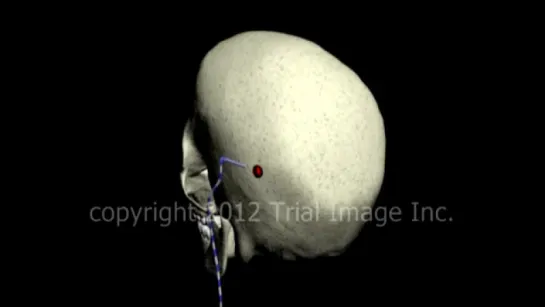 Hydrocephalus shunt