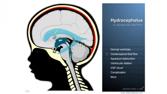 Hydrocephalus - Definition, treatment and complications