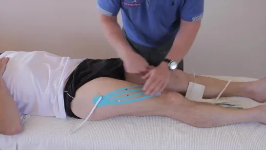 How to treat a bruise _ haematoma _ swelling of the quadriceps using kinesiology tape