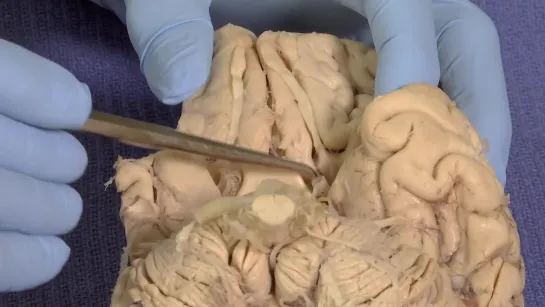 25 Olfactory Neuroanatomy Video Lab - Brain Dissectio