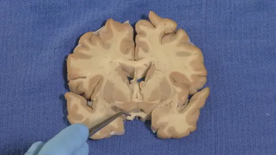 24 Hypothalamus Neuroanatomy Video Lab - Brain Dissec