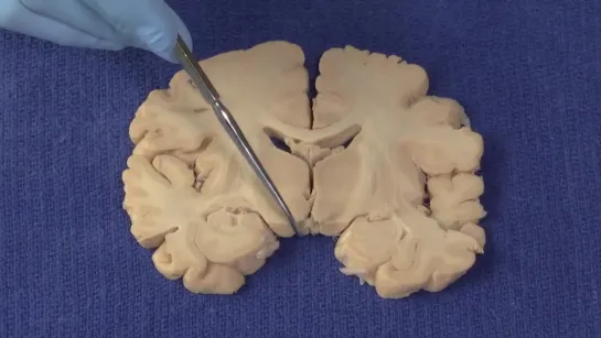 22 Basal Ganglia Neuroanatomy Video Lab - Brain Disse