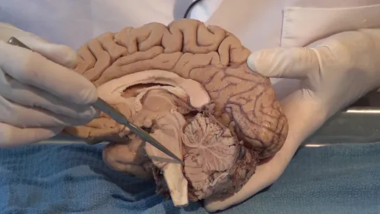 5 The Ventricles Neuroanatomy Video Lab - Brain Diss