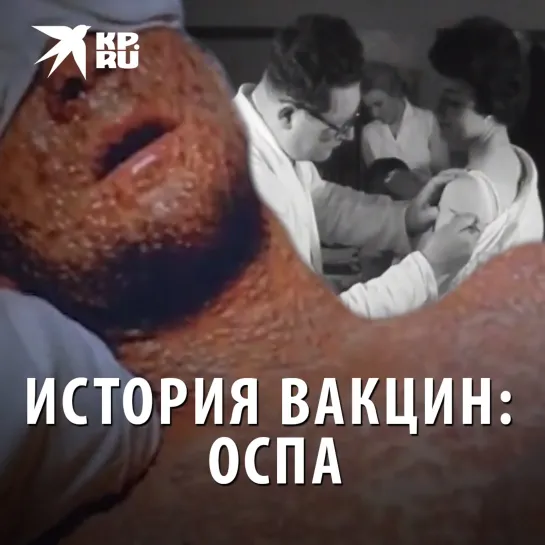 История вакцин: оспа