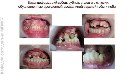 Врожденная патология челюстно - лицевой области. Стоматология.