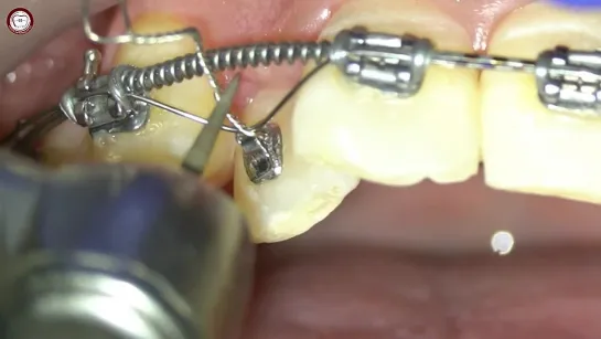 Double wire traction for palatal lateral after space opening using piggyback and ligature traction