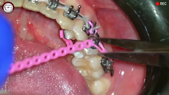 Couple opposite force for tooth de-rotation bucco-lingual mechanics