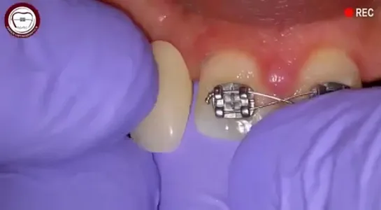 Missing lateral space maintenance during orthodontic treatment